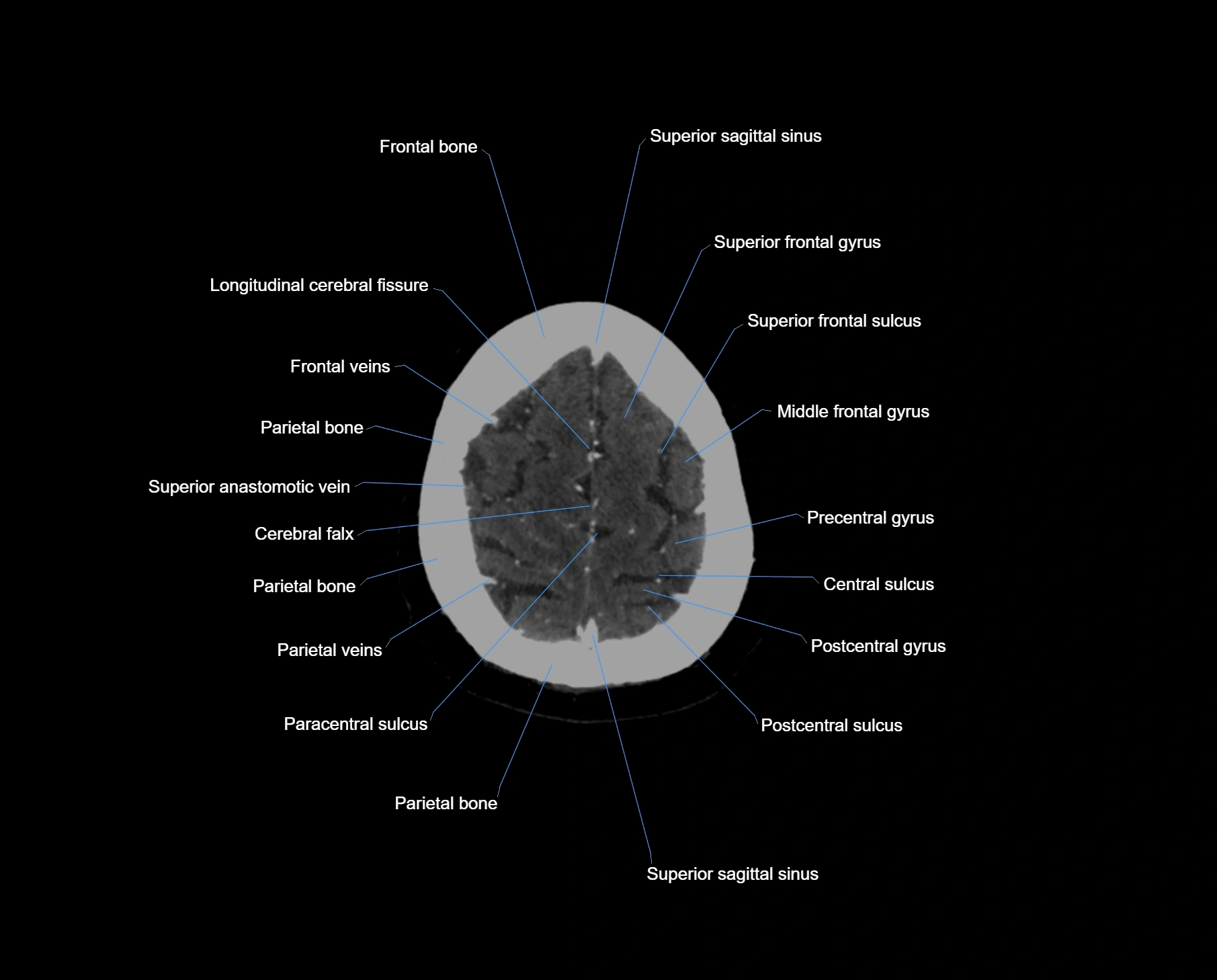 CT scan brain axial labelled cross sectional anatomy image-img-000064.webp